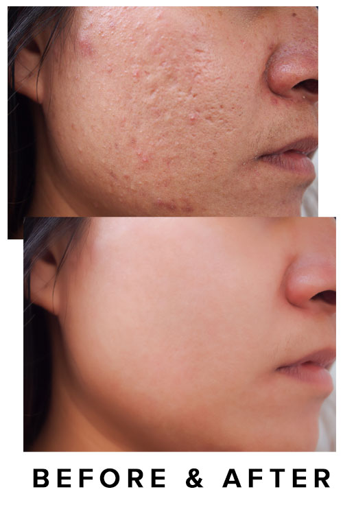 acne treatment virginia beach before & after